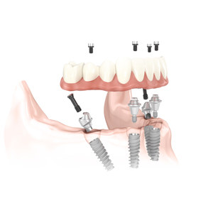 all on 4 treatment concept illustration