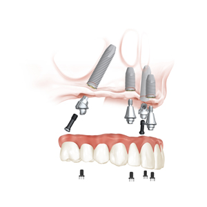 all on 4 treatment concept illustration all on 4 treatment concept illustration
