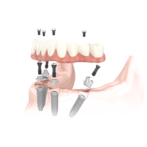 all on 4 treatment concept illustration all on 4 treatment concept illustration