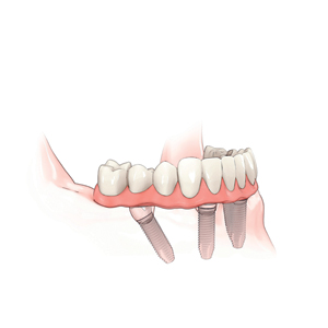 all on 4 treatment concept illustration